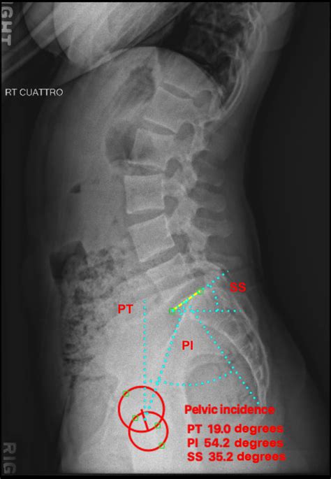 Mar 23, 2005 Answer Actually, 72050 (Radiologic examination, spine, cervical; minimum of four views) is the code that you should use when you report the scenario that you describe. . Cpt code for x ray lumbar spine 4 views